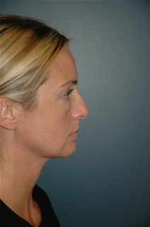 Rhinoplasty Before Photo by Richard Rand, MD; Bellevue, WA - Case 21999