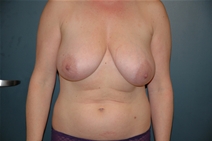 Breast Lift Before Photo by Richard Rand, MD; Bellevue, WA - Case 22283