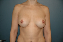 Breast Lift After Photo by Richard Rand, MD; Bellevue, WA - Case 22427