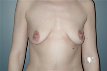 Breast Lift Before Photo by Richard Rand, MD; Bellevue, WA - Case 22427