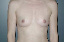 Breast Augmentation Before Photo by Richard Rand, MD; Bellevue, WA - Case 5139