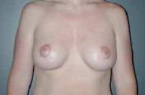 Breast Augmentation After Photo by Richard Rand, MD; Bellevue, WA - Case 5519