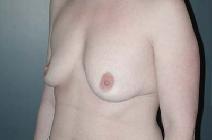 Breast Augmentation Before Photo by Richard Rand, MD; Bellevue, WA - Case 5519