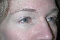 Eyelid Surgery Before Photo by Richard Rand, MD; Bellevue, WA - Case 5750