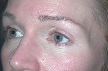 Eyelid Surgery After Photo by Richard Rand, MD; Bellevue, WA - Case 5750
