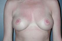 Breast Augmentation After Photo by Richard Rand, MD; Bellevue, WA - Case 5773