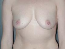 Breast Augmentation Before Photo by Richard Rand, MD; Bellevue, WA - Case 5773