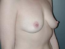 Breast Augmentation Before Photo by Richard Rand, MD; Bellevue, WA - Case 5773