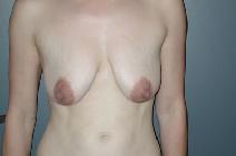 Breast Reduction Before Photo by Richard Rand, MD; Bellevue, WA - Case 5894
