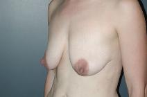 Breast Reduction Before Photo by Richard Rand, MD; Bellevue, WA - Case 5894