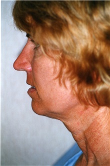 Facelift Before Photo by Franklin Richards, MD; Bethesda, MD - Case 46026