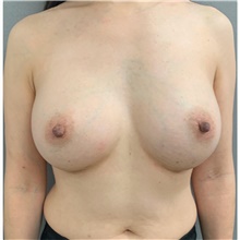 Breast Augmentation After Photo by Franklin Richards, MD; Bethesda, MD - Case 46030