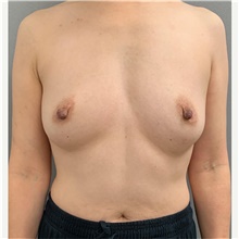 Breast Augmentation Before Photo by Franklin Richards, MD; Bethesda, MD - Case 46030
