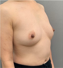 Breast Augmentation Before Photo by Franklin Richards, MD; Bethesda, MD - Case 46030