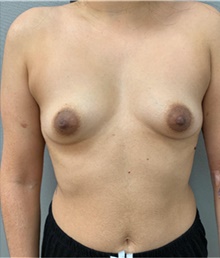 Breast Augmentation Before Photo by Franklin Richards, MD; Bethesda, MD - Case 46084