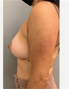 Breast Augmentation After Photo by Franklin Richards, MD; Bethesda, MD - Case 46084