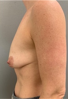 Breast Lift Before Photo by Franklin Richards, MD; Bethesda, MD - Case 46085