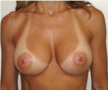 Breast Augmentation After Photo by Franklin Richards, MD; Bethesda, MD - Case 46086
