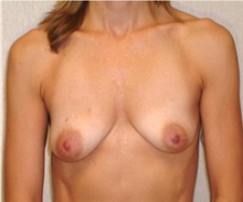 Breast Augmentation Before Photo by Franklin Richards, MD; Bethesda, MD - Case 46086