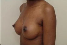 Breast Augmentation After Photo by Franklin Richards, MD; Bethesda, MD - Case 46090