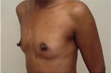 Breast Augmentation Before Photo by Franklin Richards, MD; Bethesda, MD - Case 46090