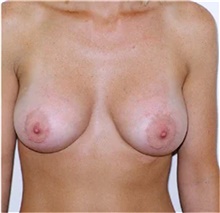 Breast Augmentation After Photo by Franklin Richards, MD; Bethesda, MD - Case 46091