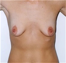 Breast Augmentation Before Photo by Franklin Richards, MD; Bethesda, MD - Case 46091