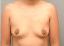 Breast Augmentation Before Photo by Franklin Richards, MD; Bethesda, MD - Case 46093