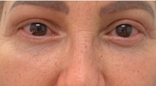 Eyelid Surgery After Photo by Franklin Richards, MD; Bethesda, MD - Case 46095