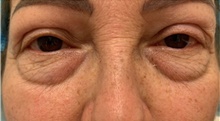 Eyelid Surgery Before Photo by Franklin Richards, MD; Bethesda, MD - Case 46095