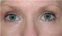 Eyelid Surgery After Photo by Franklin Richards, MD; Bethesda, MD - Case 46106