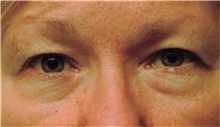 Eyelid Surgery Before Photo by Franklin Richards, MD; Bethesda, MD - Case 46106