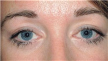 Eyelid Surgery After Photo by Franklin Richards, MD; Bethesda, MD - Case 46107