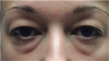 Eyelid Surgery Before Photo by Franklin Richards, MD; Bethesda, MD - Case 46107