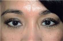 Eyelid Surgery After Photo by Franklin Richards, MD; Bethesda, MD - Case 46108