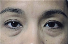 Eyelid Surgery Before Photo by Franklin Richards, MD; Bethesda, MD - Case 46108
