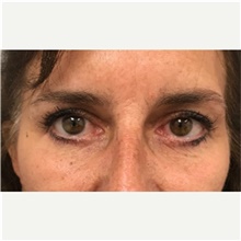Eyelid Surgery After Photo by Franklin Richards, MD; Bethesda, MD - Case 46110