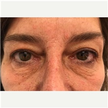 Eyelid Surgery Before Photo by Franklin Richards, MD; Bethesda, MD - Case 46110