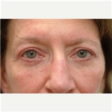 Eyelid Surgery After Photo by Franklin Richards, MD; Bethesda, MD - Case 46111