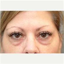 Eyelid Surgery Before Photo by Franklin Richards, MD; Bethesda, MD - Case 46113