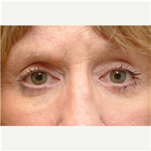 Eyelid Surgery After Photo by Franklin Richards, MD; Bethesda, MD - Case 46114