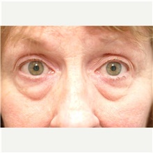 Eyelid Surgery Before Photo by Franklin Richards, MD; Bethesda, MD - Case 46114
