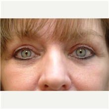 Eyelid Surgery After Photo by Franklin Richards, MD; Bethesda, MD - Case 46115