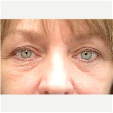 Eyelid Surgery Before Photo by Franklin Richards, MD; Bethesda, MD - Case 46115