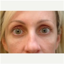 Eyelid Surgery After Photo by Franklin Richards, MD; Bethesda, MD - Case 46118