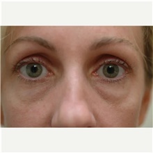 Eyelid Surgery Before Photo by Franklin Richards, MD; Bethesda, MD - Case 46118
