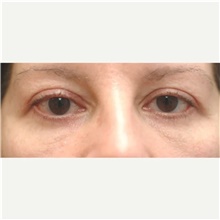 Eyelid Surgery After Photo by Franklin Richards, MD; Bethesda, MD - Case 46119