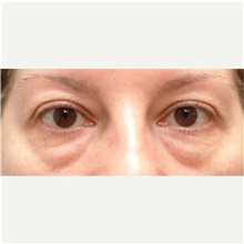 Eyelid Surgery Before Photo by Franklin Richards, MD; Bethesda, MD - Case 46119