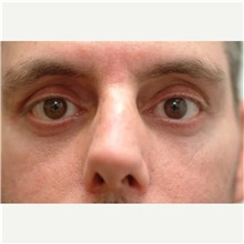 Eyelid Surgery After Photo by Franklin Richards, MD; Bethesda, MD - Case 46120