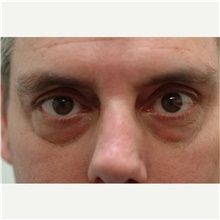 Eyelid Surgery Before Photo by Franklin Richards, MD; Bethesda, MD - Case 46120